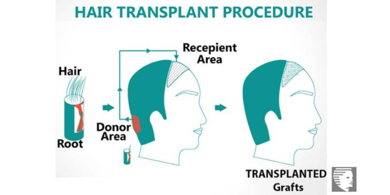 5 Things A Person Will Learn Post A Hair Transplant