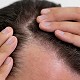 A Guide to Maintain Perfect Scalp Health