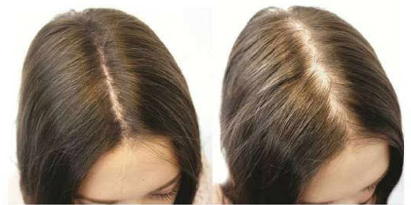 Noticeable change in your hairline