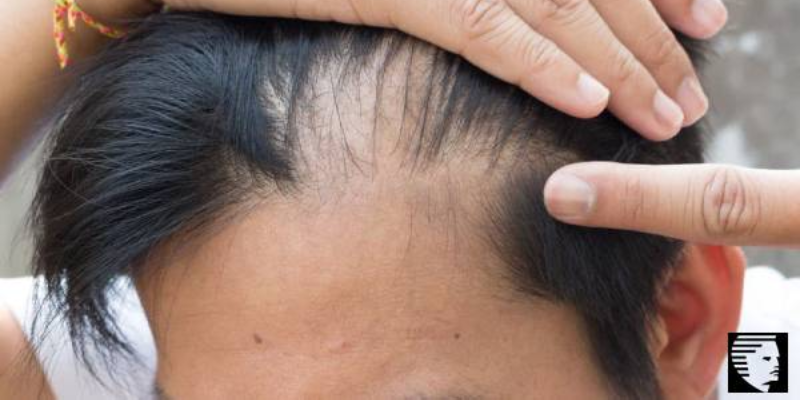 Excessive Hair Loss  Here's How To Hold Them Back