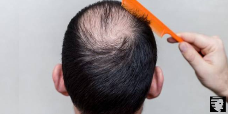 HAIR LOSS? GENETIC OR ENVIRONMENTAL?