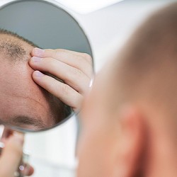 Unravelling Premature Balding: Causes, Signs, Treatments, and More