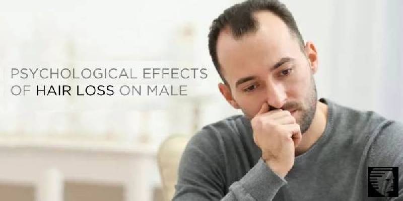 Psychological Effects of Hair Loss on Male