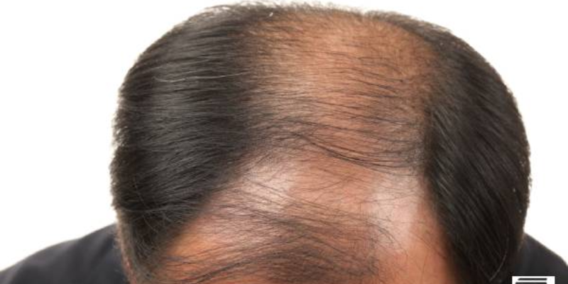 Reasons of hair loss – Prevention & its Cure
