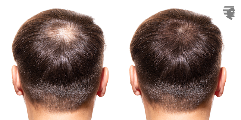 Do you Need A Second Hair Loss Treatment