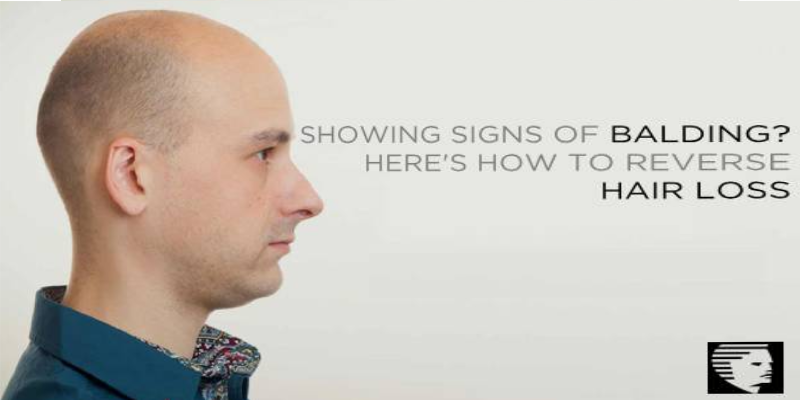 Showing Signs of Balding? Here's How to Reverse Hair Loss!
