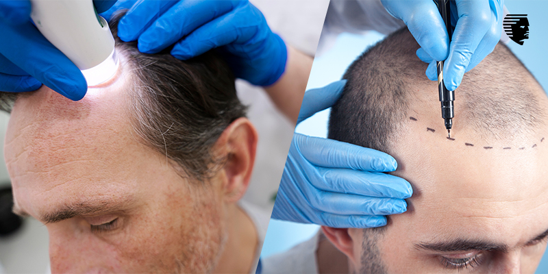 The Truth About Hair Restoration: Synthetic Hair Transplant Vs. Natural Hair Transplant