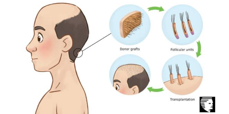 WHAT IS THE BASIC BUILDING BLOCK FOR HAIR TRANSPLANTATION