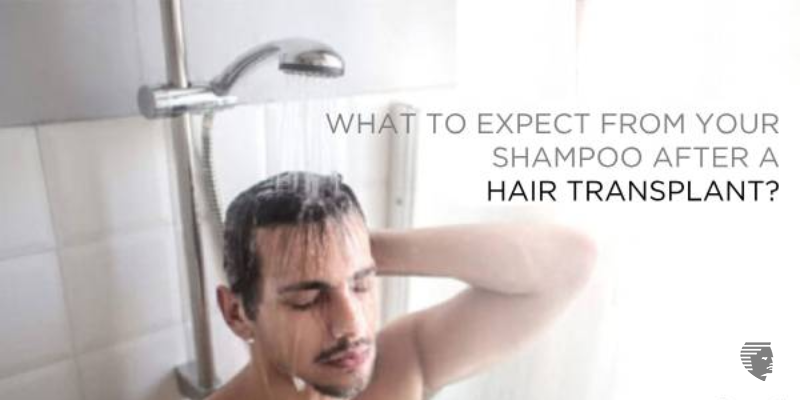 What to Expect from Your Shampoo After a Hair Transplant
