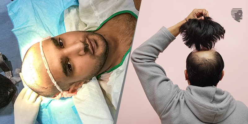 Permanent Wigs or Hair Transplant Surgery: Which One Should I choose