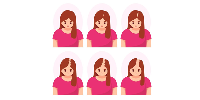 Ludwig Scale and Female Hair Loss: Understanding the Different Stages
