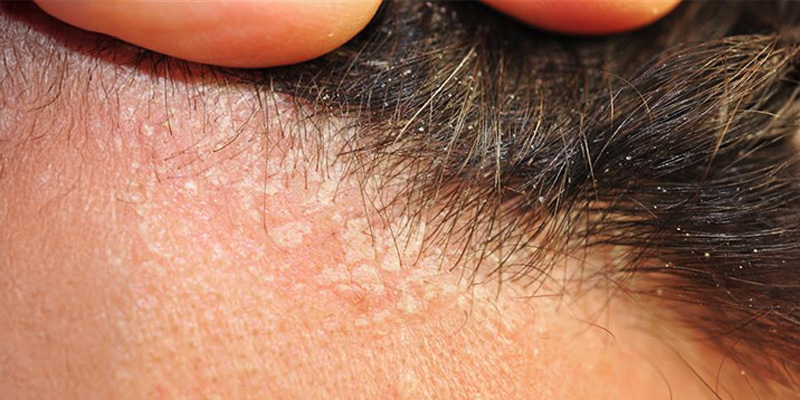 A Guide to Scalp Eczema: Causes, Symptoms and Treatments