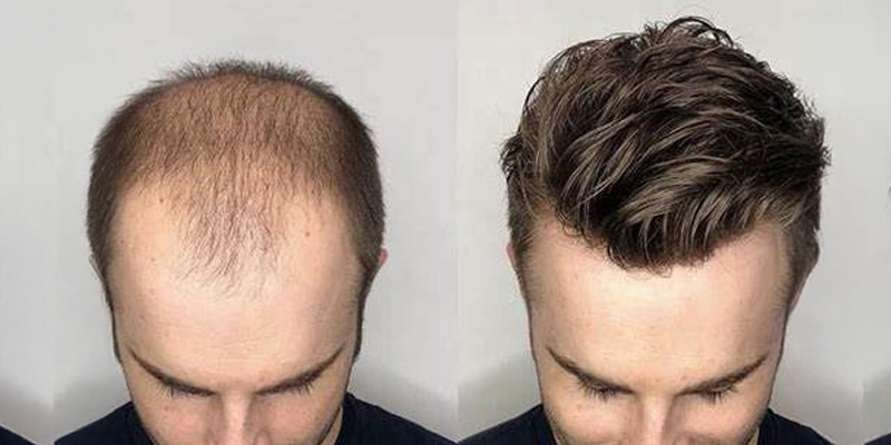 Hair Wigs & Hair Patches for Men in Bangalore | AHS India