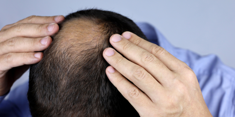 Crown Hair Loss Explained: Why It Happens and How to Stop It