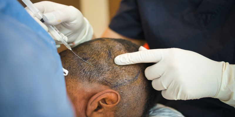 How to Calculate Hair Transplant Cost Per Follicle Based on Your Hair Loss Stage