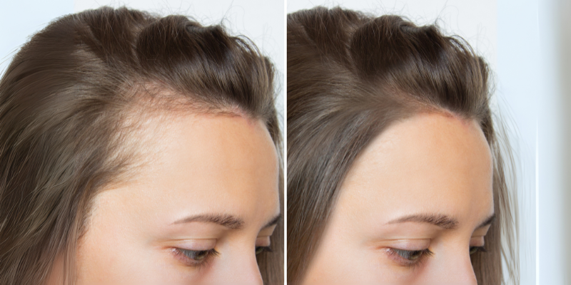 Natural Hairlines Are Possible: How Hair Transplants Deliver Results