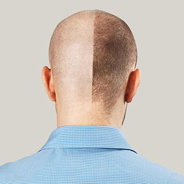 Can Hair Transplant Be the Permanent Hair Restoration Treatment?