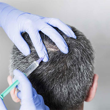 The Success Rate of Hair Transplant Procedure