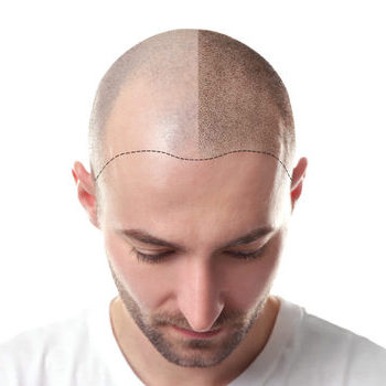 Things to Consider Before Undergoing Surgical Hair Treatment