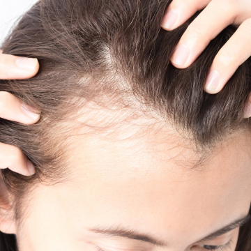 Is Inflammation in Your Body Causing Hair Loss?