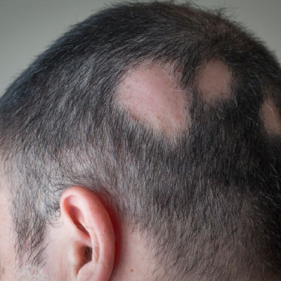 Is Cicatricial Alopecia permanent?