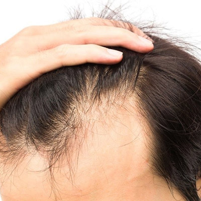 What You Can Do About Men’s Thinning Hair?
