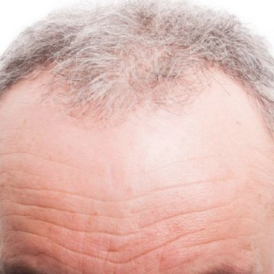 Forehead Hair loss: Signs & Causes
