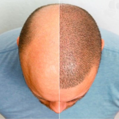Hair Transplant to Increase Hair Density: Does it Work?