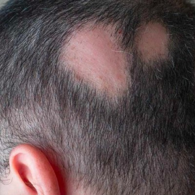 Why Is Hair Loss Diagnosis Important Before Hair Transplantation?