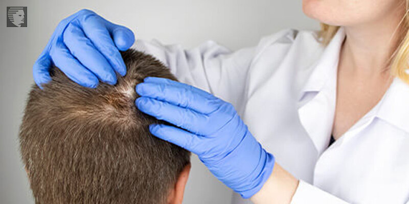 Hair Restoration Growth Timeline: What to Expect