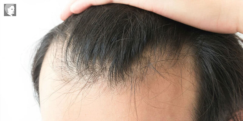 10 Causes of Hair Loss and Baldness in Men