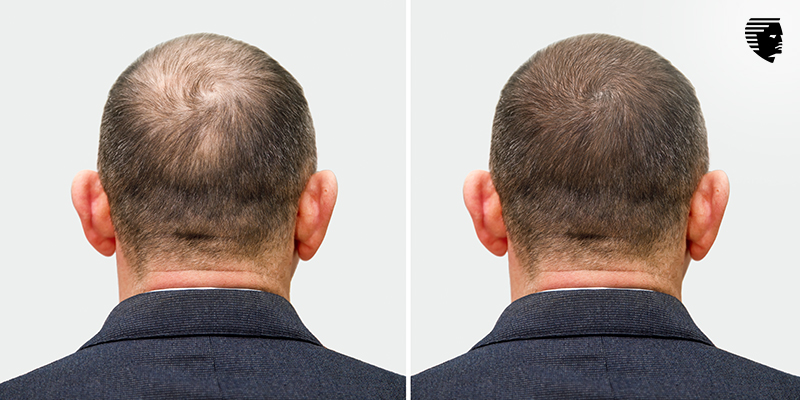 Is Hair Transplant a Plastic Surgery
