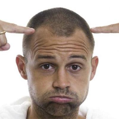 Male Pattern Baldness - Hair Loss & Hair Regrowth