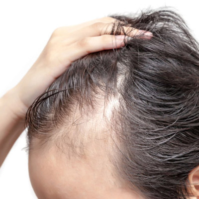 Anxiety and Stress Leading Hair Loss