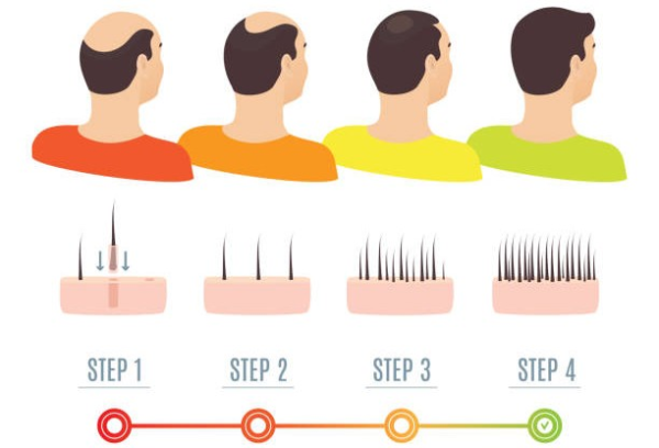 5 Qualities you really need in a Hair Transplant Service