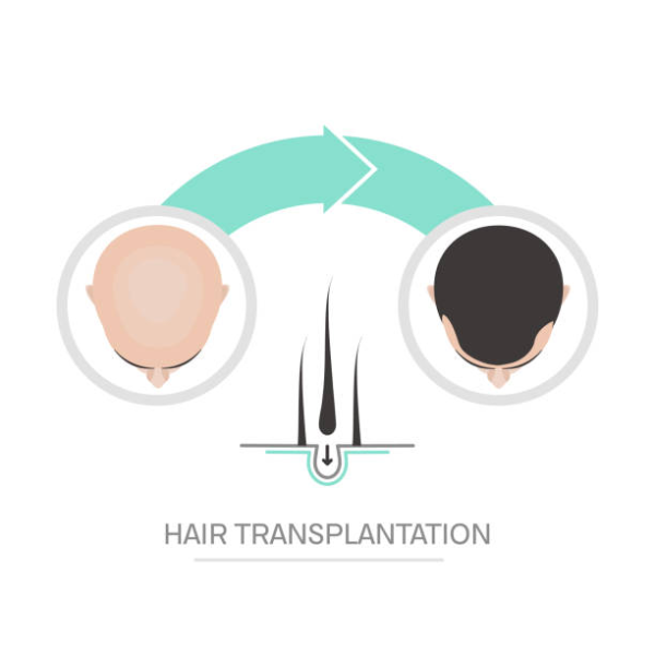7 things to consider before having a transplant