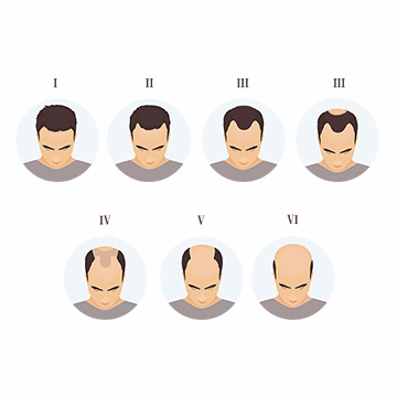 Various Stages of Baldness & How to Treat It