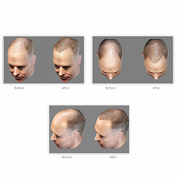 Does Hair Transplants Really Long Forever?  Experts Talk