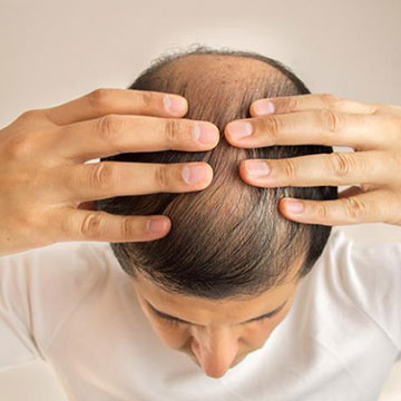 Experiencing Baldness At A Young Age? Here’s How To Counter It!