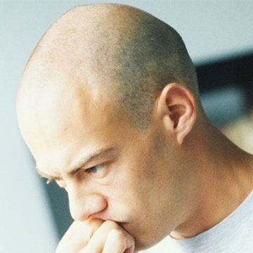 5 Things You Should Know Before You Go For A Hair Transplant