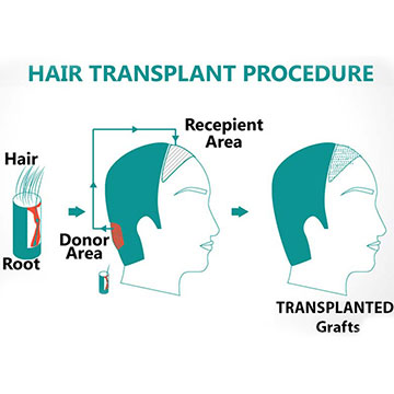 5 Things A Person Will Learn Post A Hair Transplant