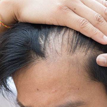 Excessive Hair Loss ? Here's How To Hold Them Back !