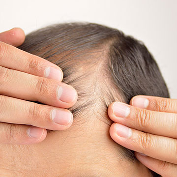 6 Prominent Causes of Hair Loss in Men