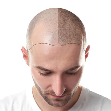 5 REASONS TO GO FOR AHS HAIR RESTORATION PROCEDURES