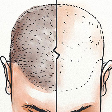 HAIR RESTORATION, WHAT’S THE FUTURE HOLDING?