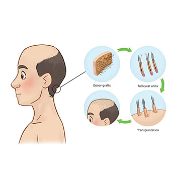 WHAT IS THE BASIC BUILDING BLOCK FOR HAIR TRANSPLANTATION?