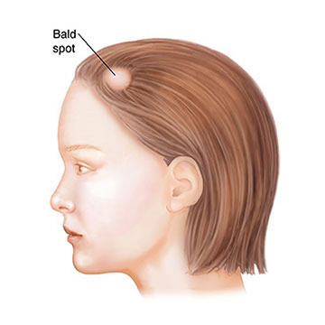 FIND OUT WHICH TYPE OF ALOPECIA HAS AFFECTED YOUR SCALP!