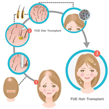 Things You Might Want to Know about FUE Hair Transplant Methodology