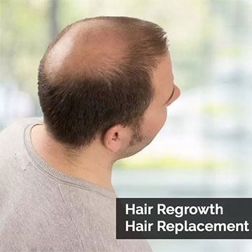 Hair Regrowth for Men - The Safest Hair Replacement Option for Men