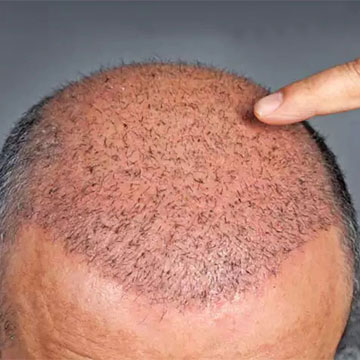 Can A Hair Transplant Restore Receding Temples & Hairline?